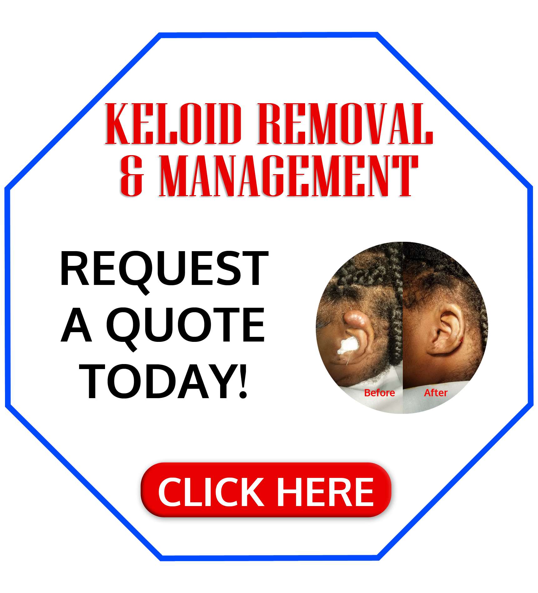 keloid removal